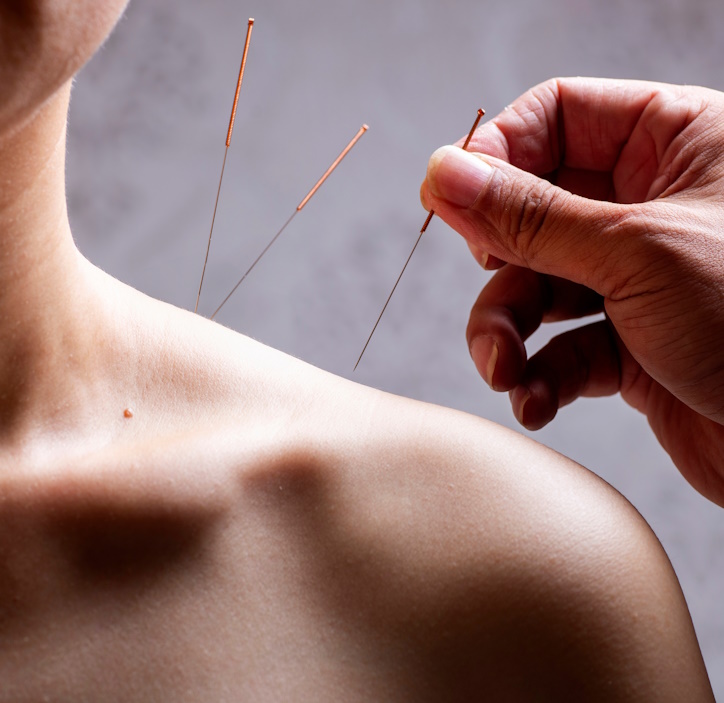 acupuncture